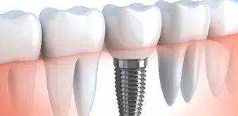 Dental Implants St. Charles, MO