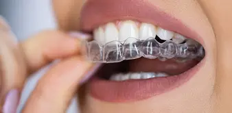 Clear Aligners St. Charles, MO