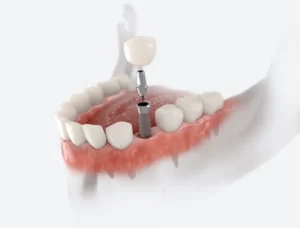Why Dental Implants Are Worth It For Tooth Loss in St. Charles, MO