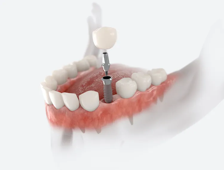 Why Dental Implants Are Worth It For Tooth Loss in St. Charles, MO